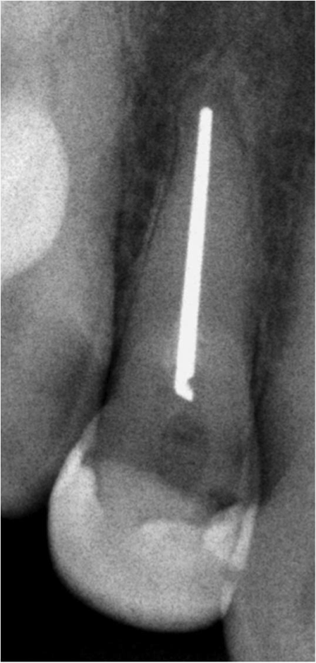 Figure 1: Pre-Operative tooth #7