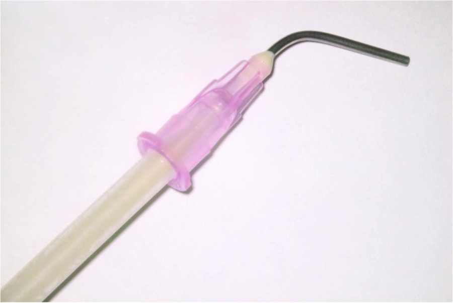Figure 6: Filling the 18-gauge composite applicator tip with a dual-cure composite